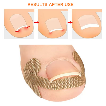 Professional Ingrown Toenail Correction Kit