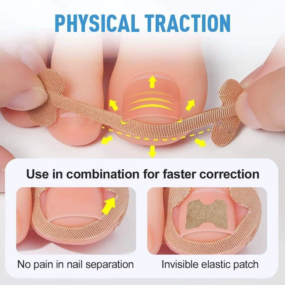 Professional Ingrown Toenail Correction Kit